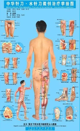 水针刀胸背部肌筋膜疼痛综合征临床病例